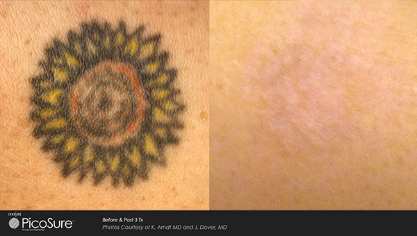 Tattoo Removal Before  After Photos Tattoo Removal Patient Results