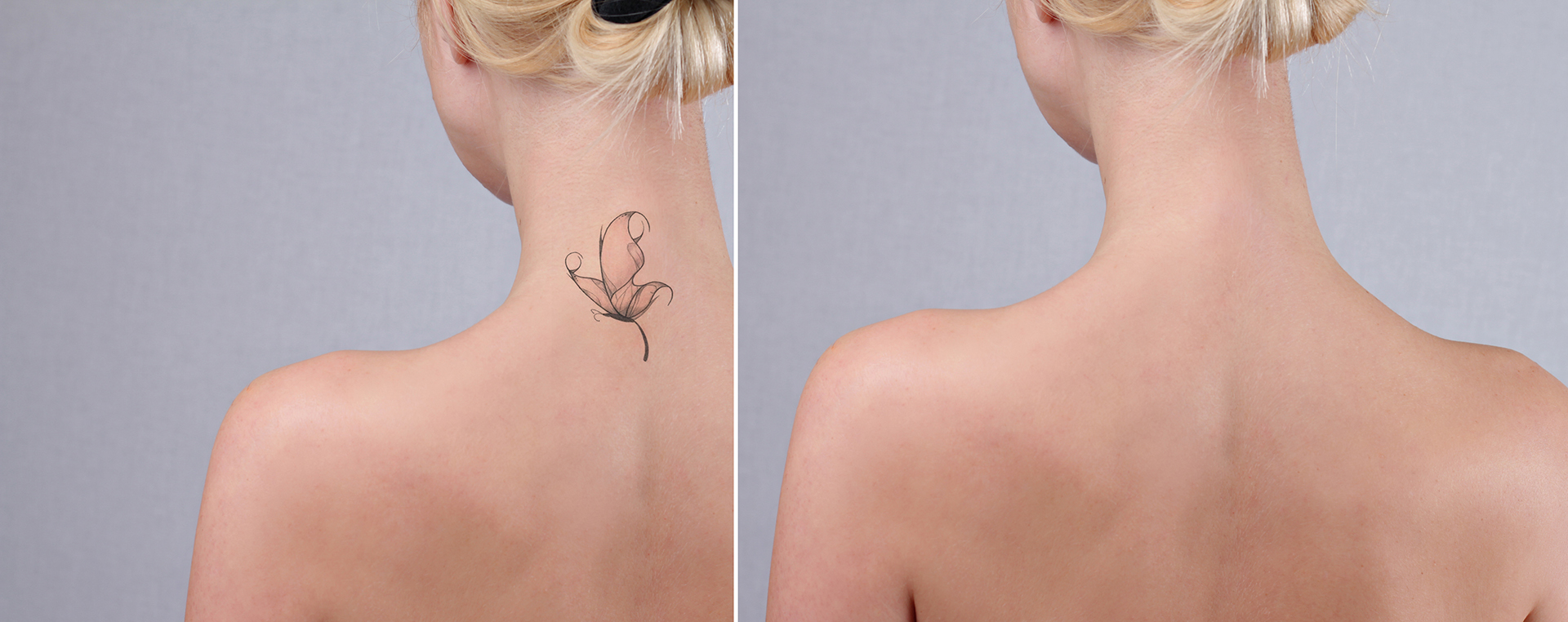 Here’s How to Make Your<br>Tattoo Regret Go Away.