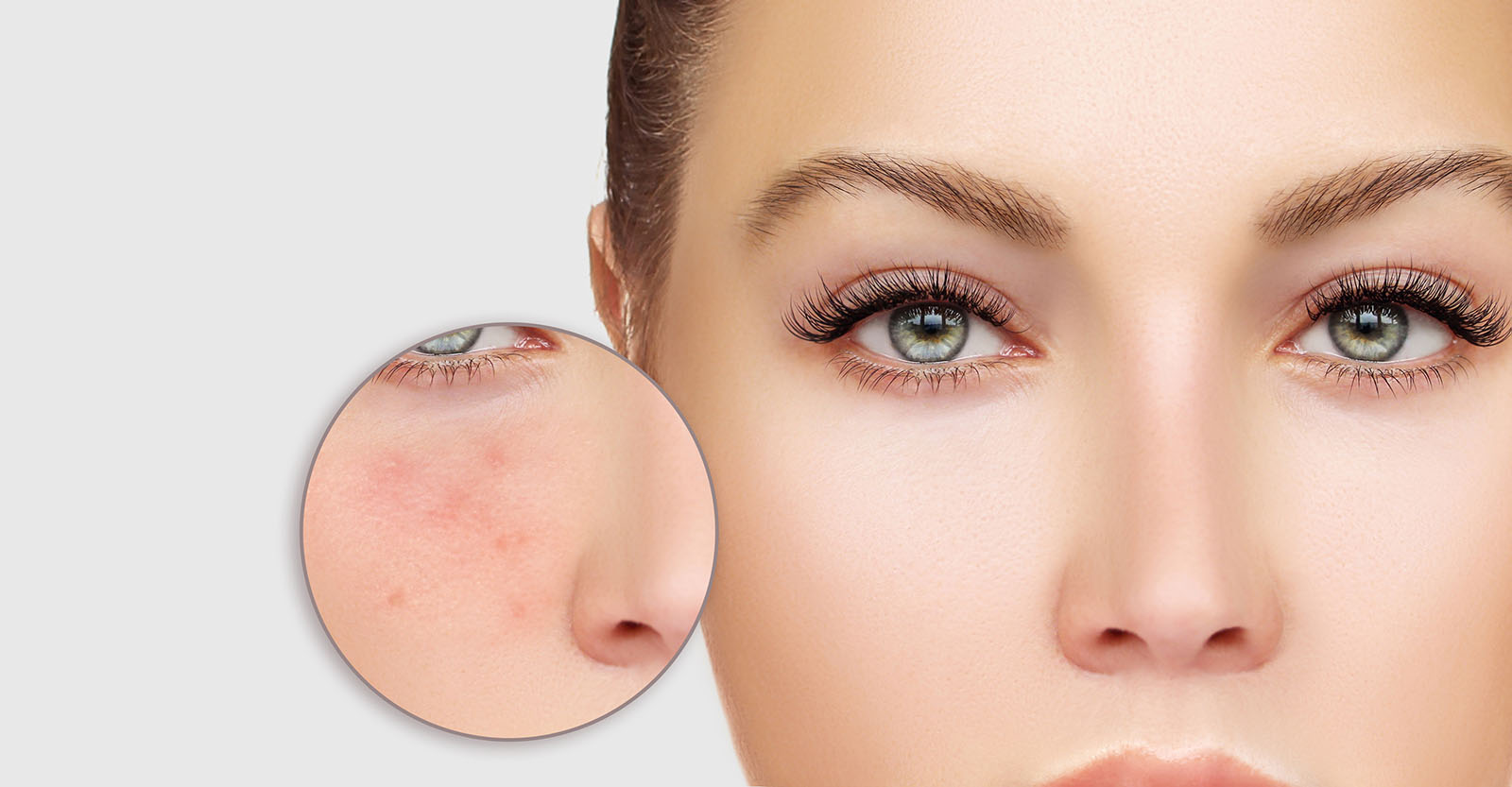 What You Should Know About Acne